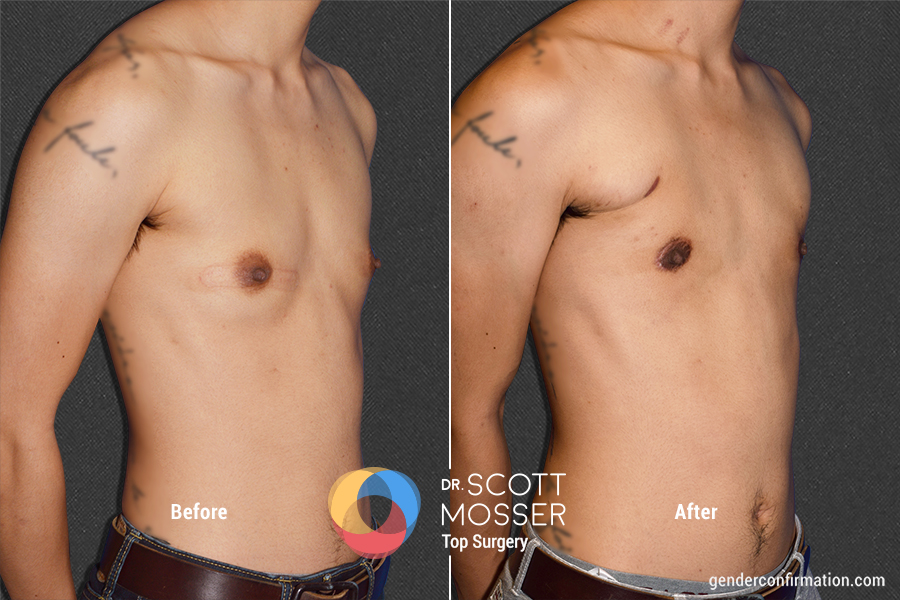 Mastopexia Periareolar Fotos Antes E Depois Periareolar / Donut - Gender Confirmation