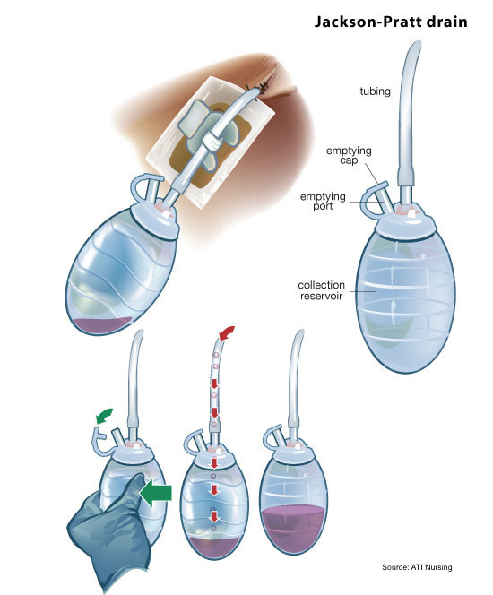 Jackson Pratt Drainage Chart