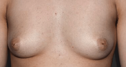 Free nipple graft_before
