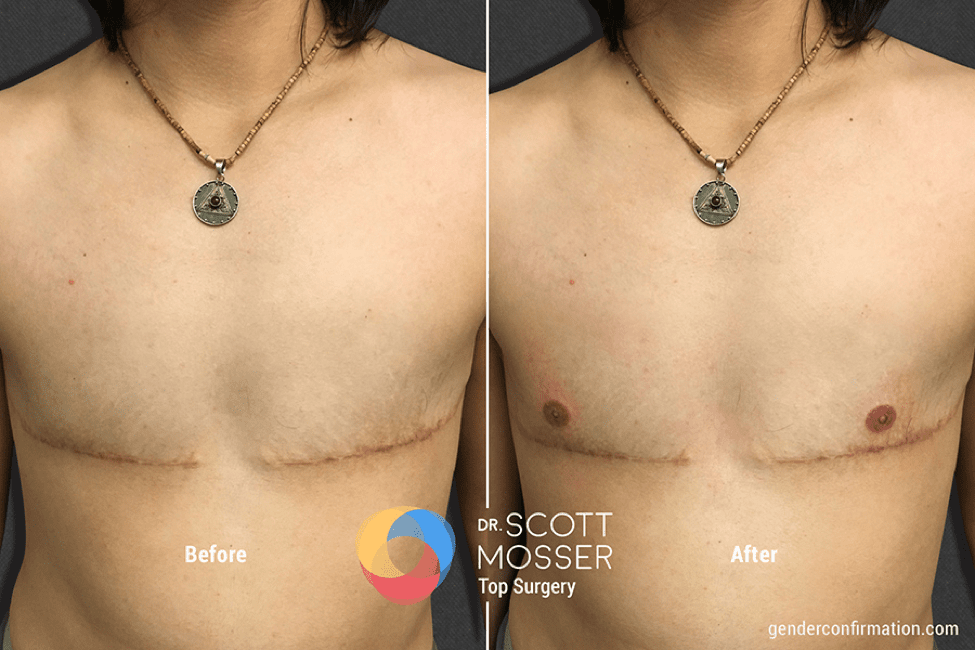 Top surgery 3D nipple tattoo_1
