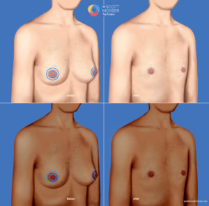 Top surgery periareolar inisicion