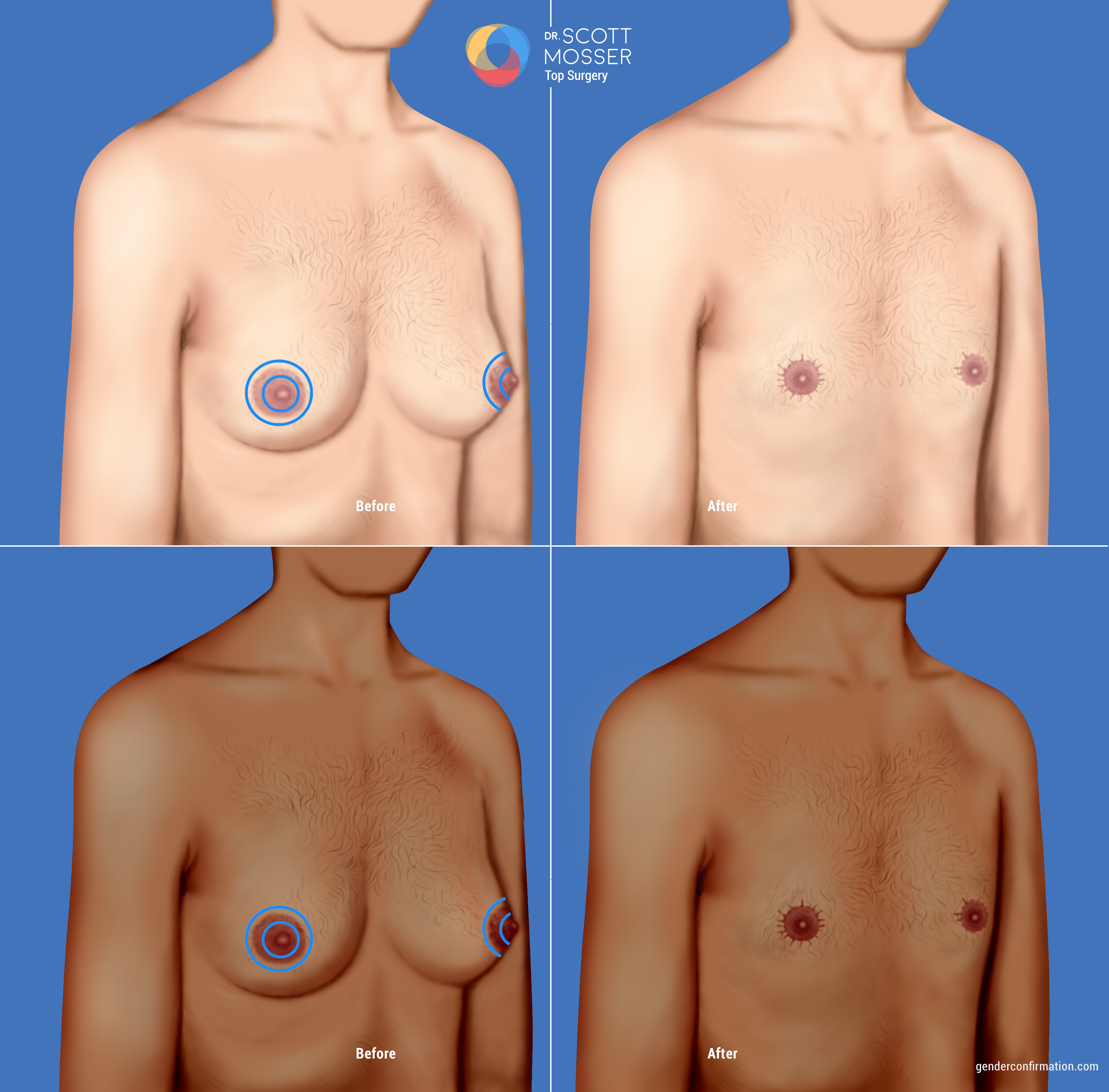 The Pros and Cons of Breast Reduction: Exploring Different Breast
