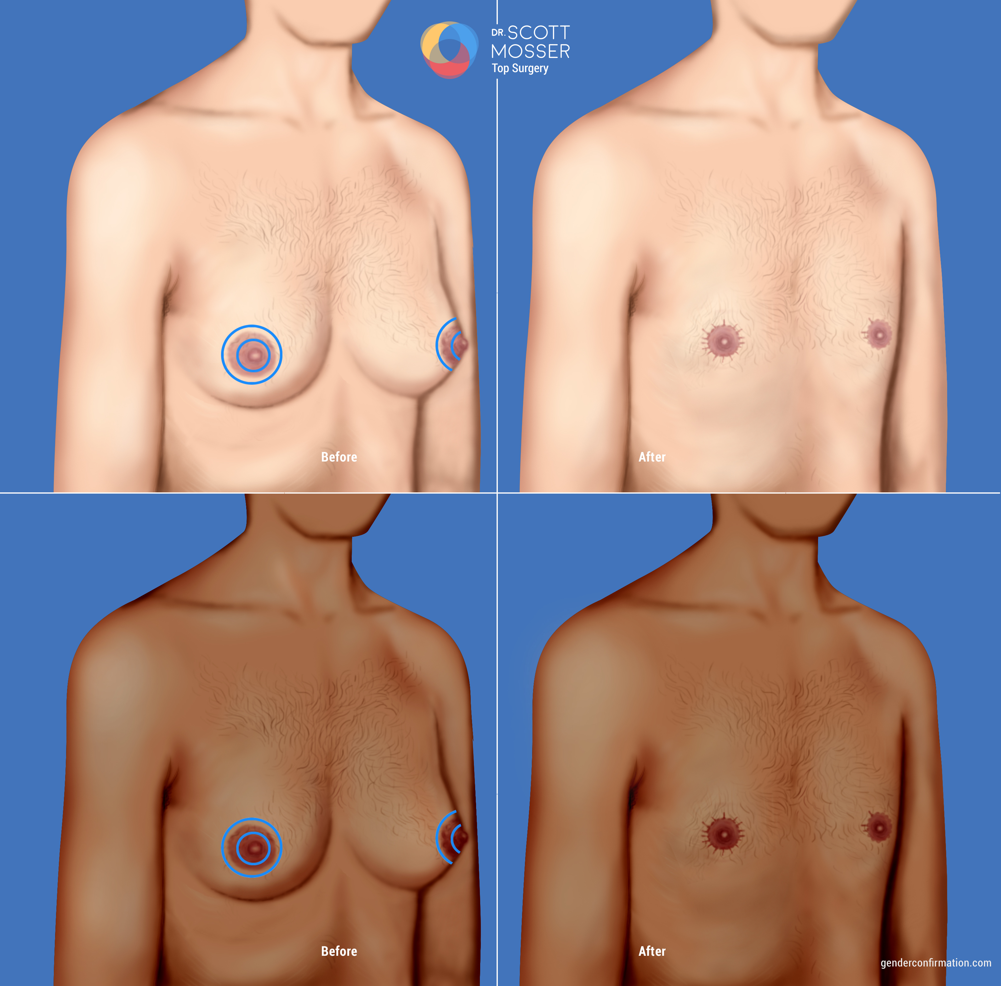 Types of Top Surgery