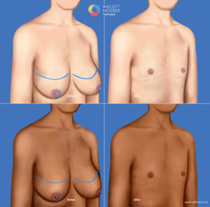 Top surgery double inisicion