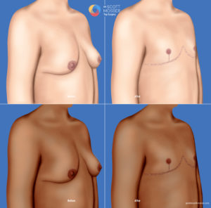 Top surgery inverted-T and buttonhole inisicion