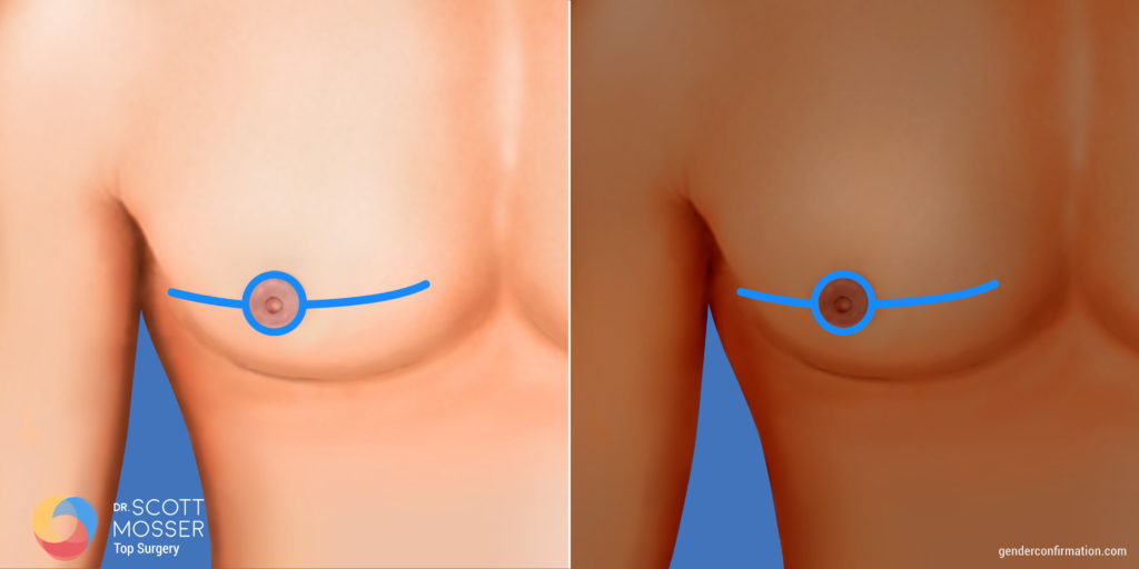 Fishmouth incision top surgery