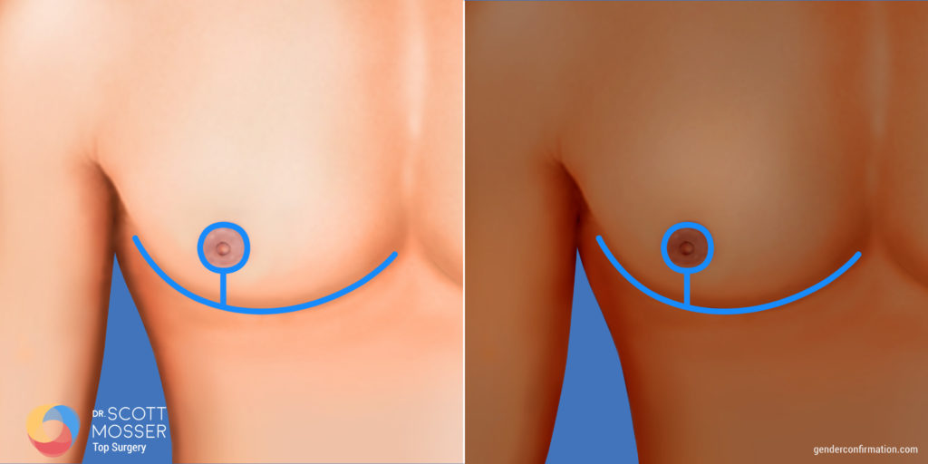 Inverted T chest reconstruction