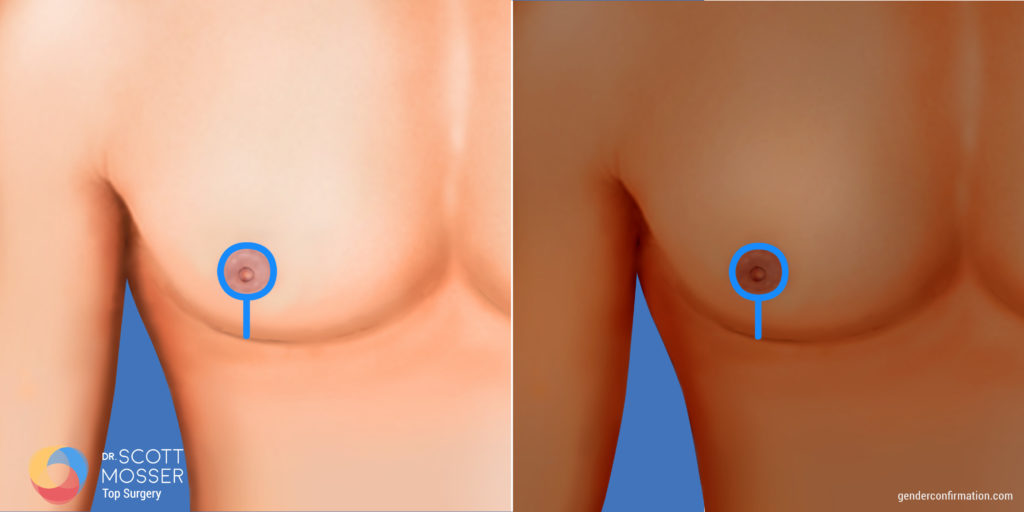 Lollipop incision for chest recontruction