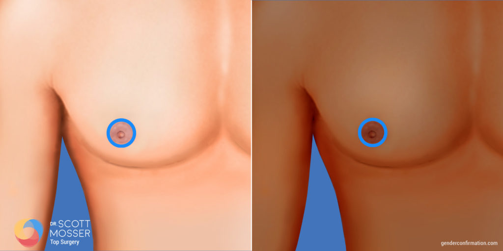 Periareolar chest reconstruction
