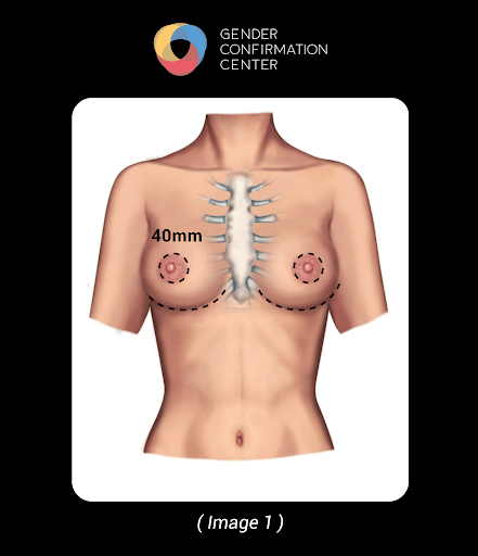 Non-binary Top Surgery Techniques