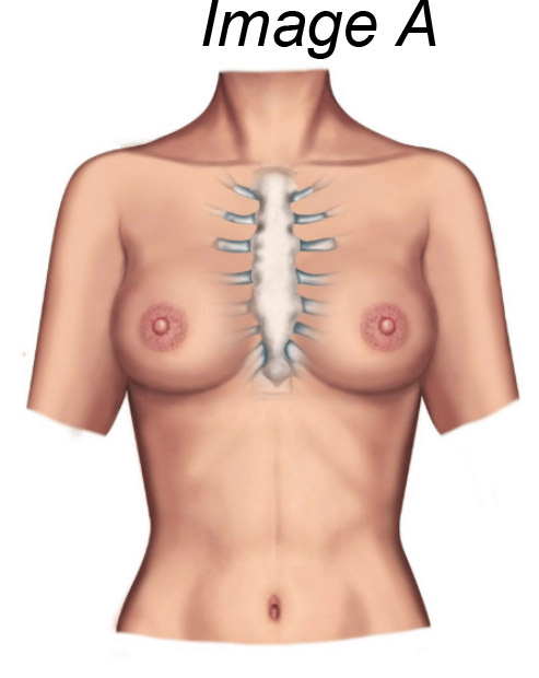 Chest Fullness and Breast Reduction