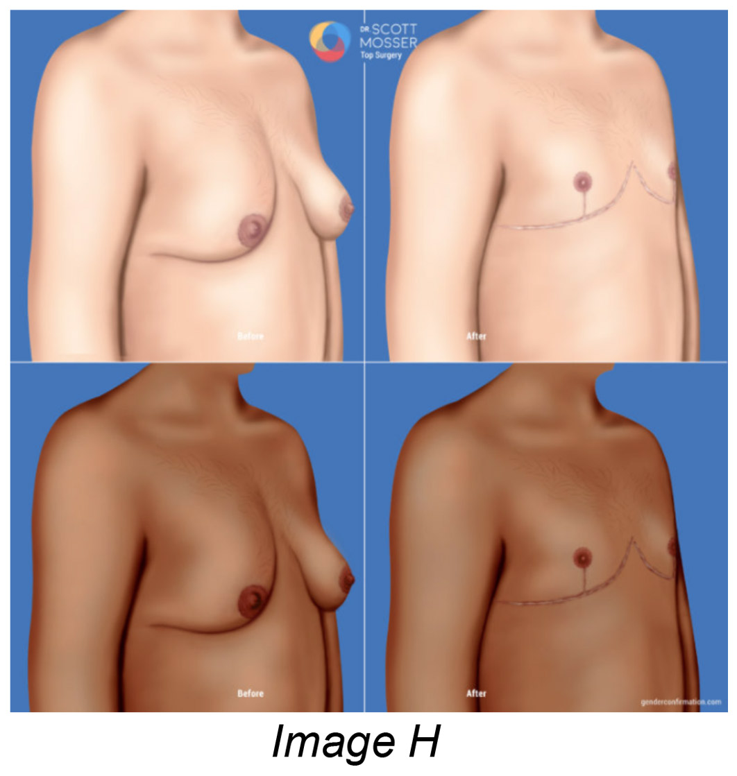 Inverted T top surgery