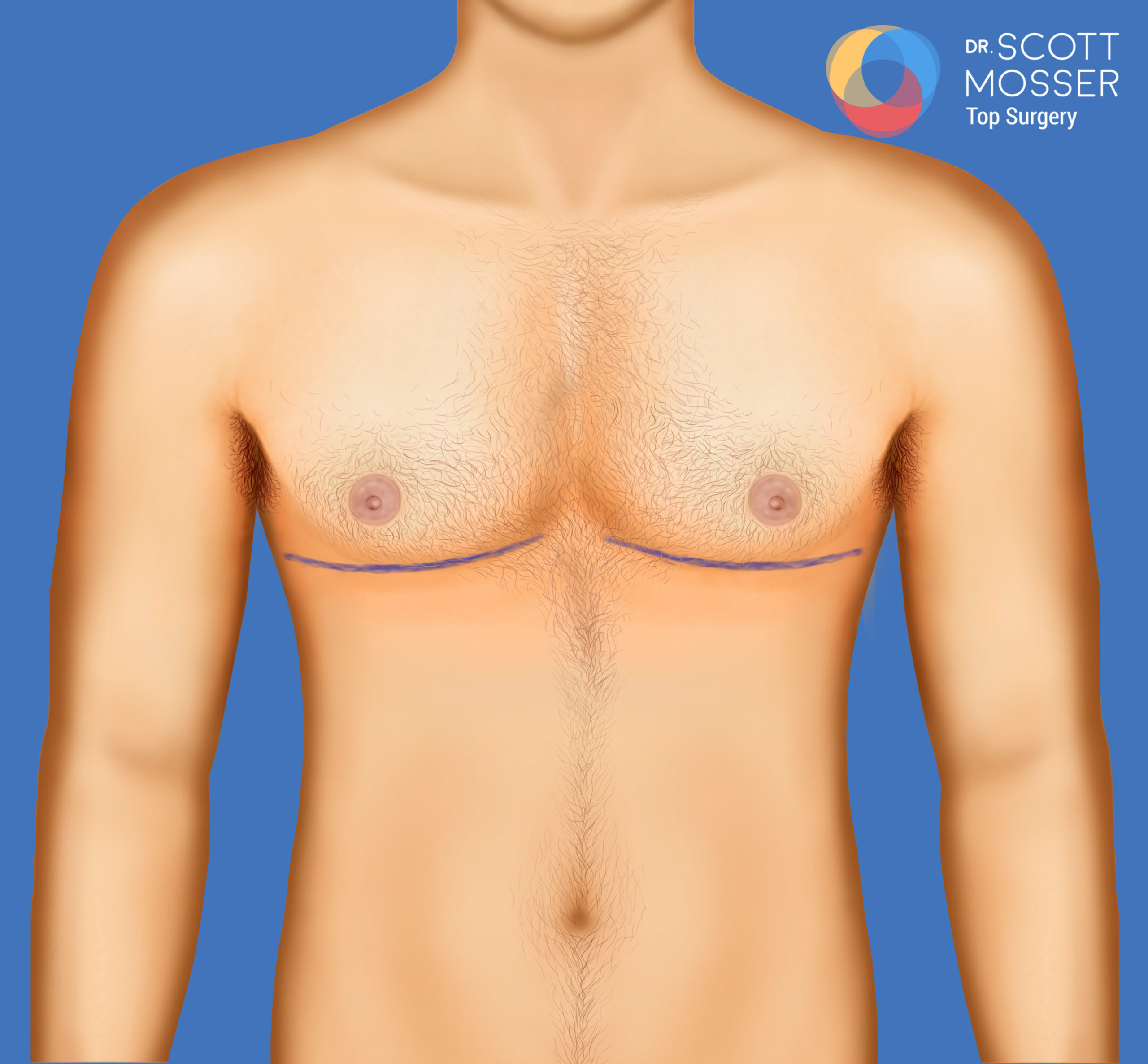 Chest Masculinization Before & Afters