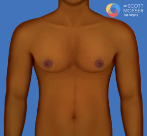 Breast Implants Nipple On Top