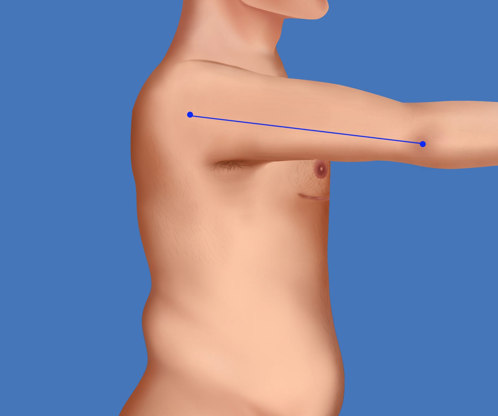 Arm mobility after top surgery