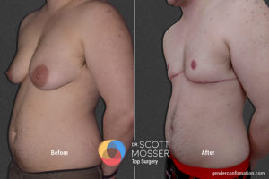 B11_4_Before_After_900X600