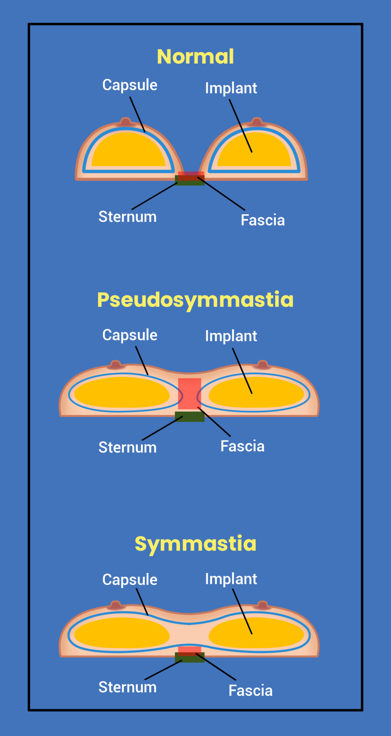 Symmastia: What It Is and How to Fix It