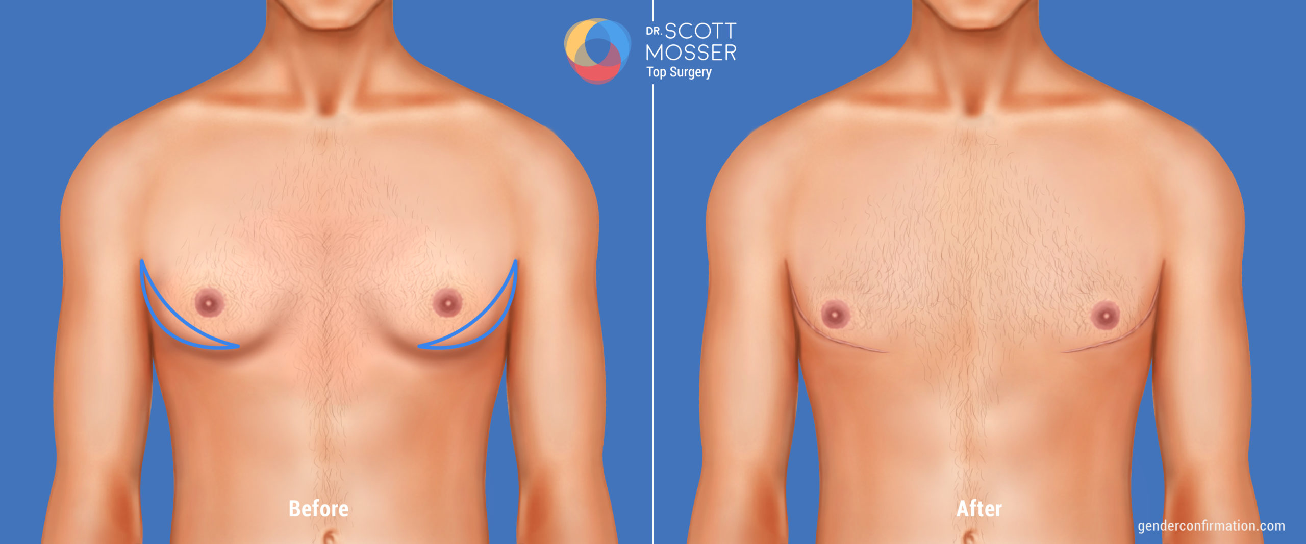 Nipple-sparing Double Incision Top Surgery