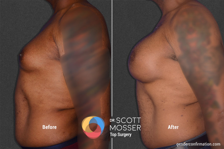 Breast Augmentation - Gender Confirmation Breast Augmentation - Gender Confirmation