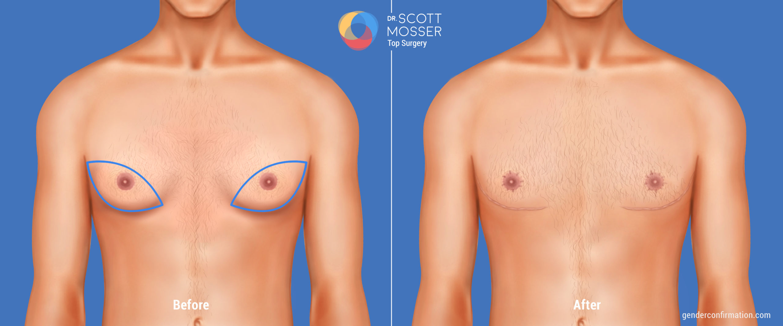  Muscle border double insicion approach