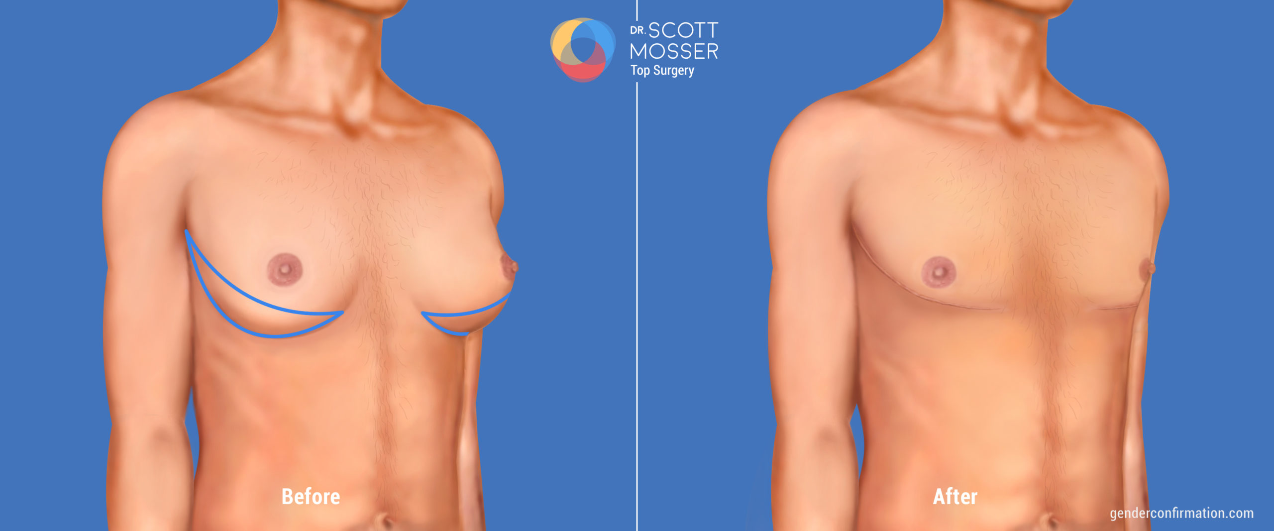 Nipple-sparing Double Incision Top Surgery