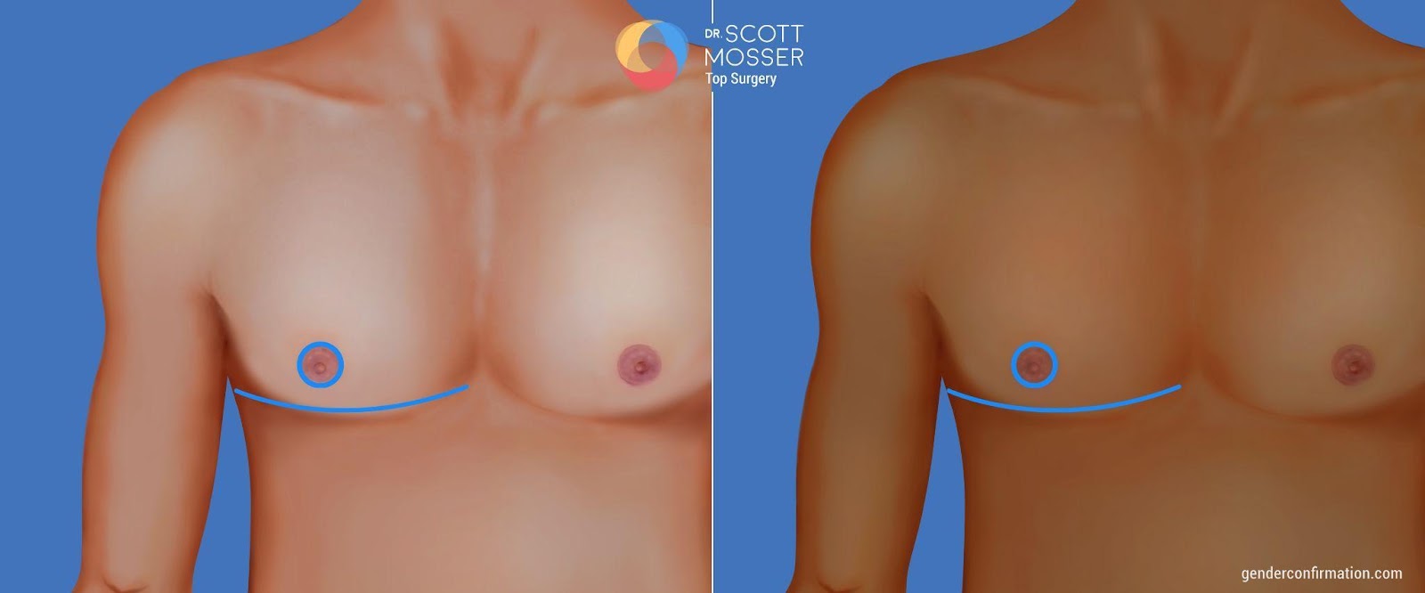 Buttonhole incision for top surgery or breast reduction