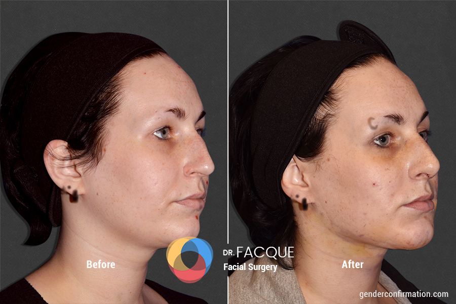 Facial Masculinization Surgery Gender Confirmation