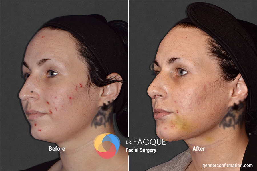 Facial Masculinization Surgery Gender Confirmation