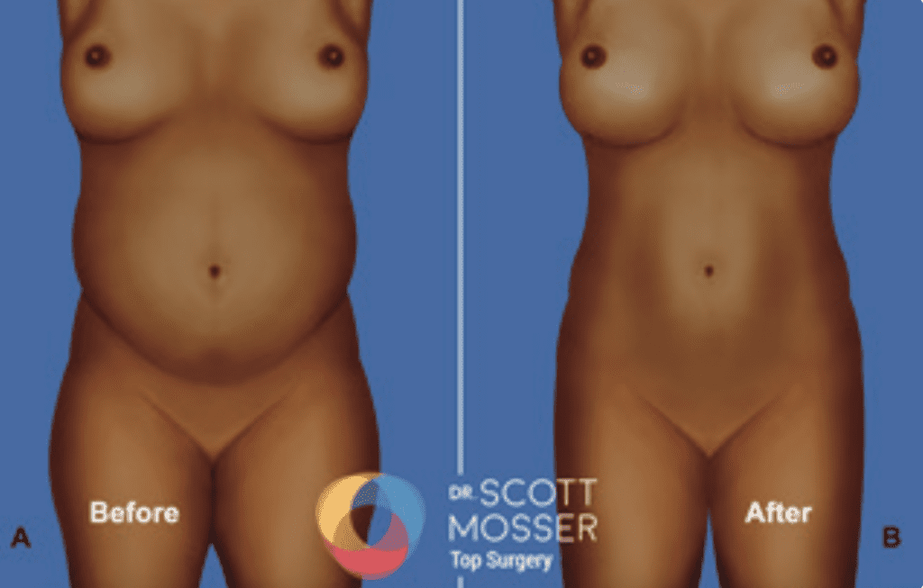 Feminizing Waist Liposuction San Francisco