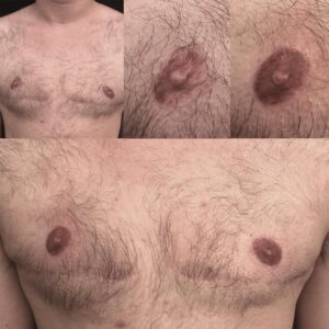  Areola tattoo before and after - Shane Wallis