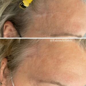 Scar camouflaging before and after - Candice Falcon