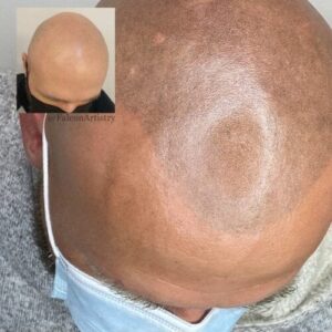 Scalp Micropigmentation before and after - Candice Falcon