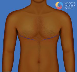 Top surgery without nipples