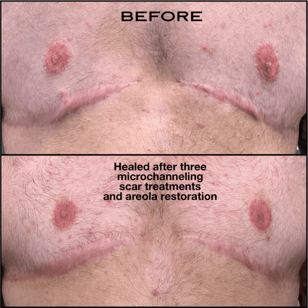 ftm top surgery scars: microchanneling therapy before and after