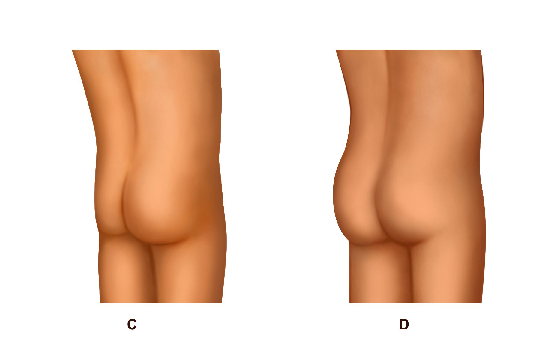 Patient Gets MTF Hip Implant, Liposuction + Fat Transfer Body