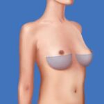 Choosing which top surgery procedure is right for you_4