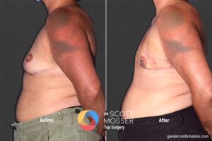Double Incision Revision - Gender Confirmation