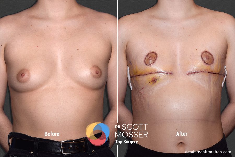  The areola size was their preference, based on their nonbinary identity goals.
