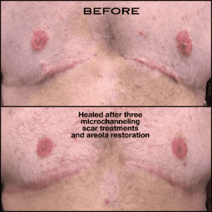 Microchanneling before and after - Jen Lee