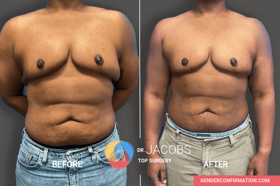 Double Incision Revision - Gender Confirmation