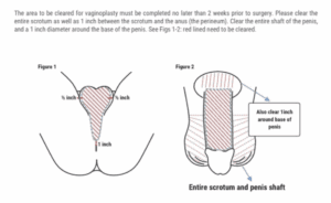 MTF Vaginoplasty