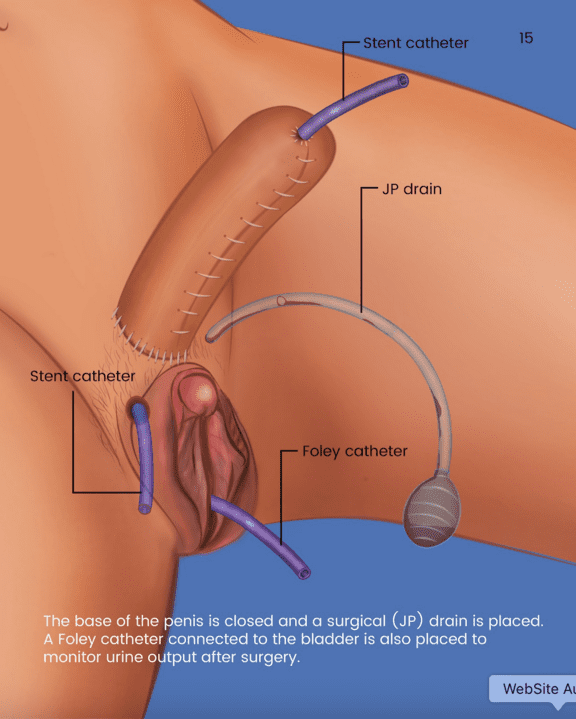 rff-phalloplasty-15.png