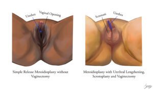 Simple Metoidioplasty vs Complex Metoidioplasty with Vaginectomy and Scrotoplasty