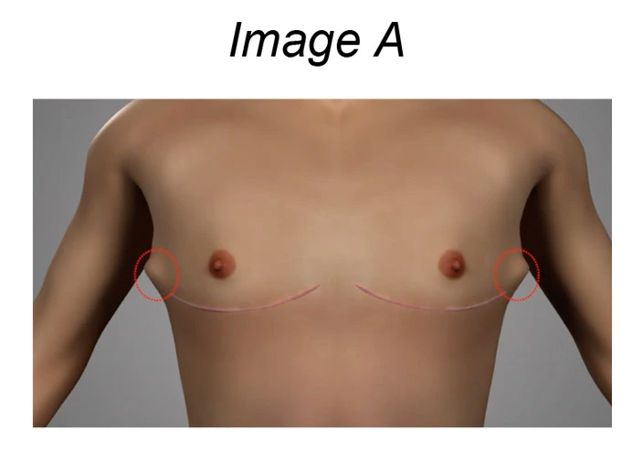 Top Surgery Dog Ears