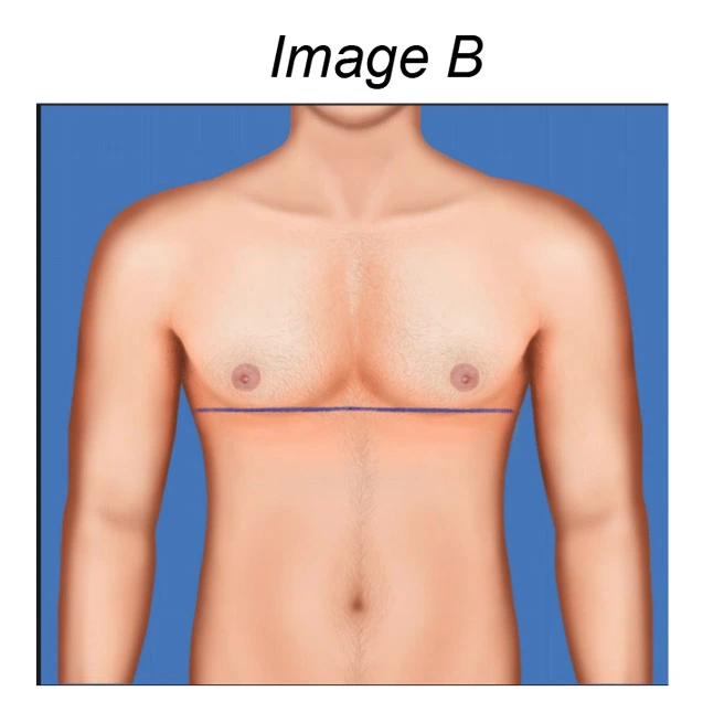 Top Surgery Insicion Crosses Chest Line