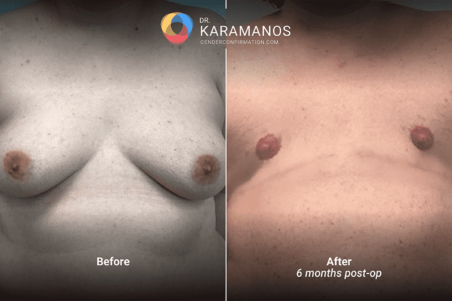 dr_k_1.3_DI_FNG_6mos_front