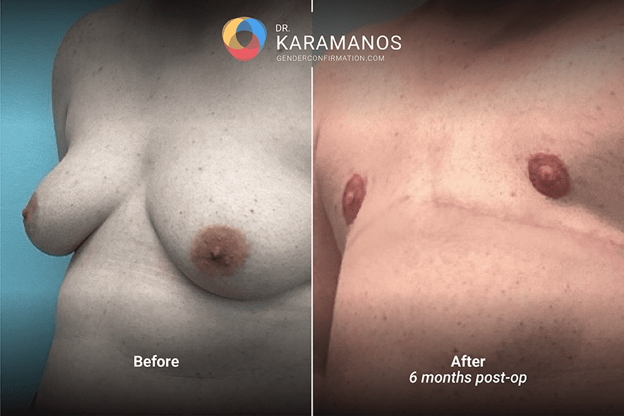 dr_k_1.3_DI_FNG_6mos_left_45