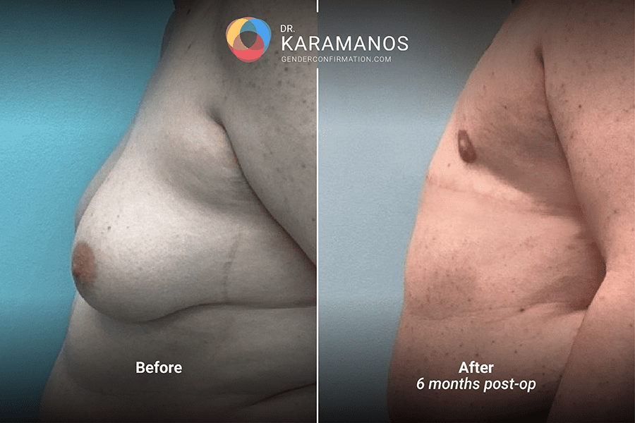 dr_k_1.3_DI_FNG_6mos_left_90