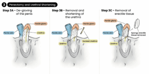 How Is Bottom Surgery Done - Gender Confirmation