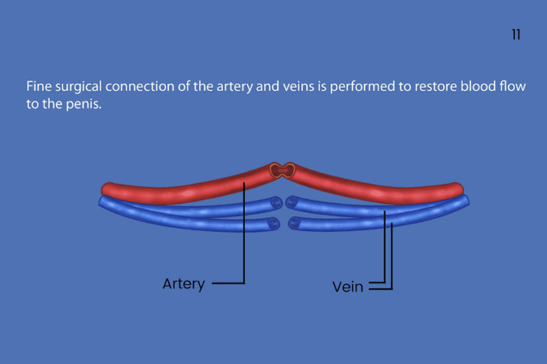 How Is Bottom Surgery Done - Gender Confirmation